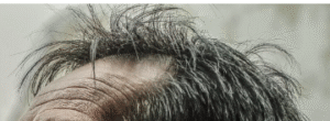 Receding hairline straight hair.